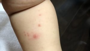 手足口病による発疹ができた娘の腕の写真