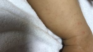 手足口病による発疹ができた娘の足の写真